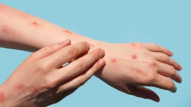 monkeypox_on_arm_and_hand.jpg